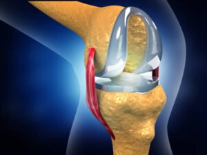 Best Joint Replacement Treatment in Shalimar Garden